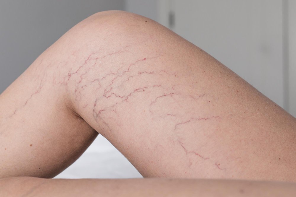 Trusted Spider Vein Treatment & Care in Venice, FL