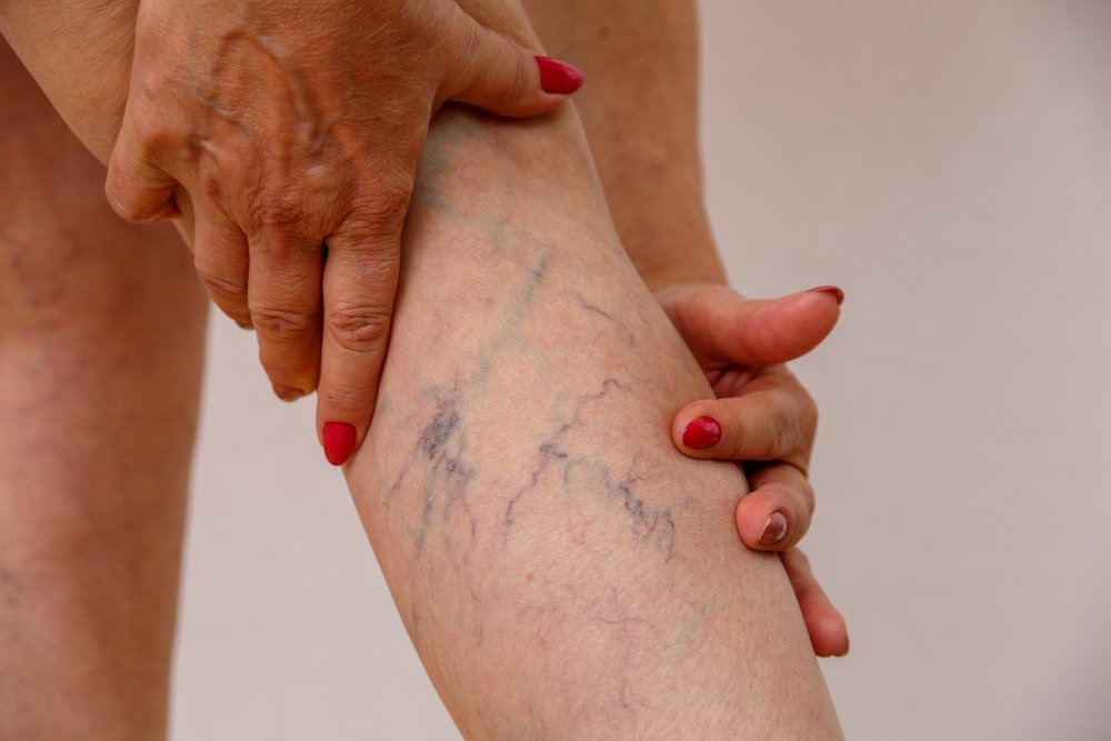Varicose Vein Treatment & Care | Advanced Health Associates
