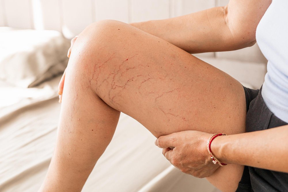 Get advanced vein care at Advanced Health Associates