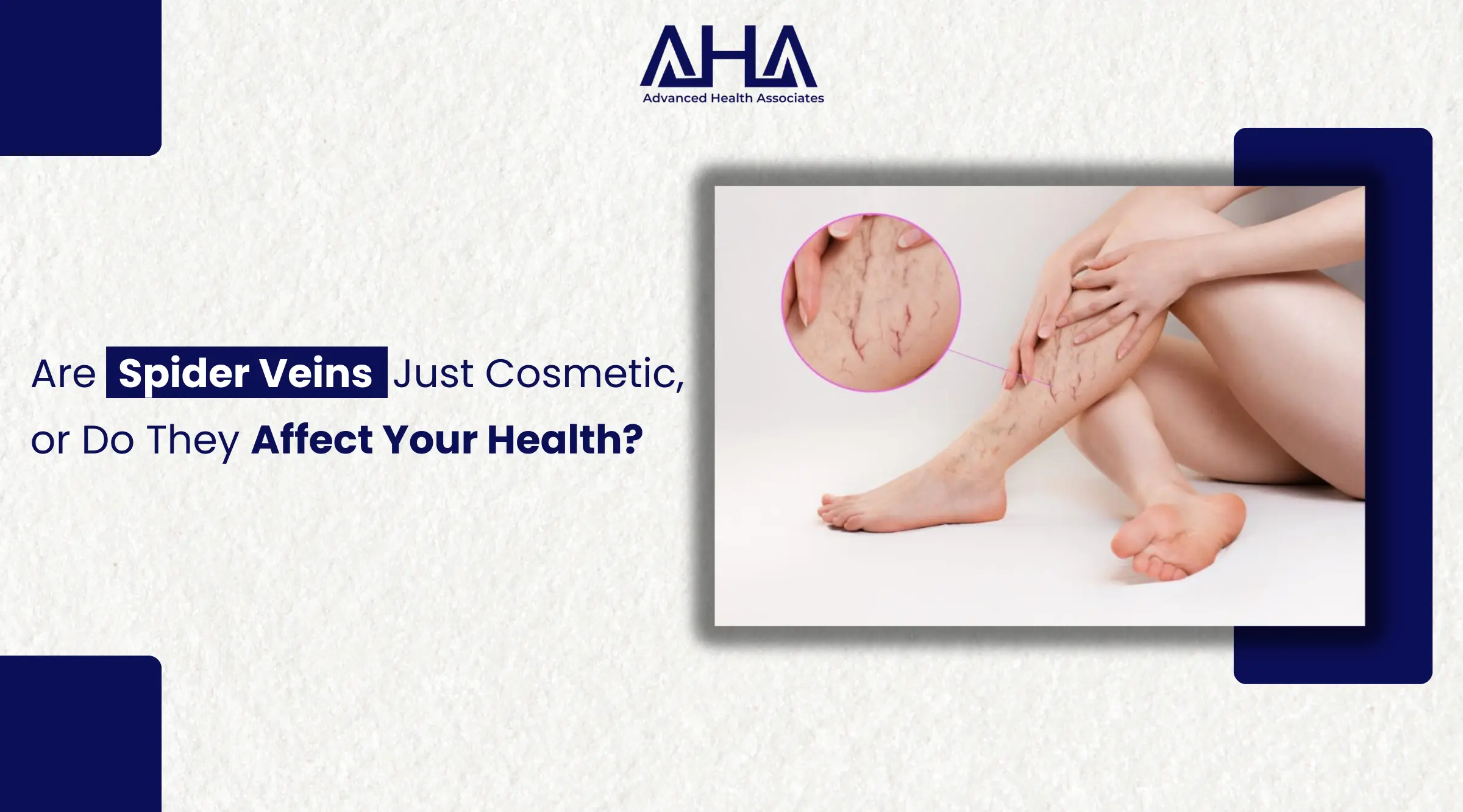 Are Spider Veins Just Cosmetic, or Do They Affect Your Health